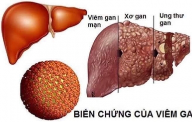 VIÊM XOANG